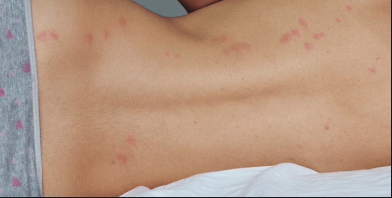Common Health Issues Associated with Bed Bug Exposure