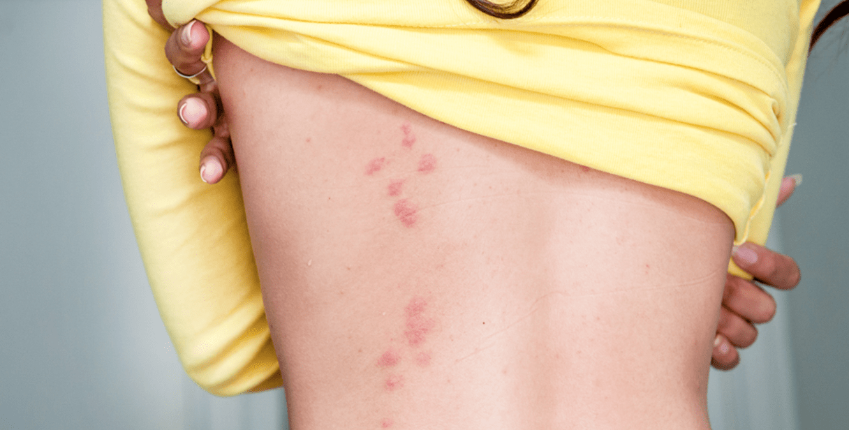 How to Properly Diagnose a Bed Bug Bite