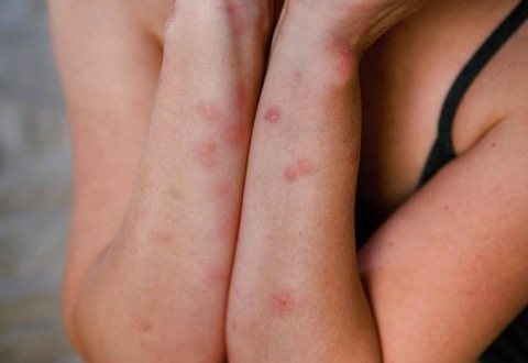 bugs bed signs body waking red bites bumps check