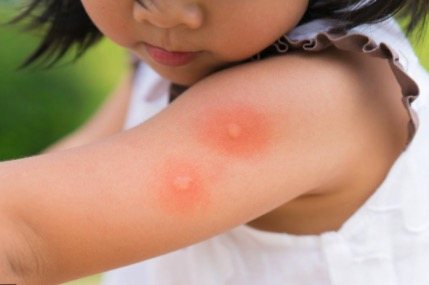 What Do Bed Bug Bites Look Like 10 Pictures Case Examples Full Guide