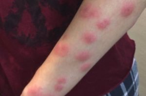 bed bug bites big welts