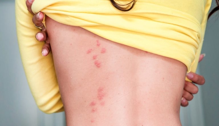 what do bed bug bites look like