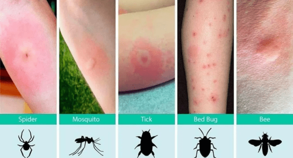 Identify Bug Bites On Humans   Bug Bite Chart 