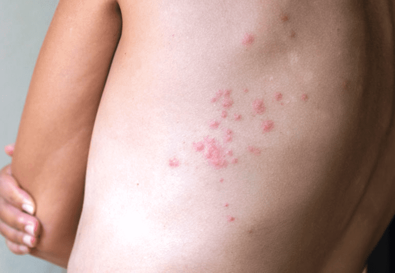 Large cluster of Bites on a Woman's Back