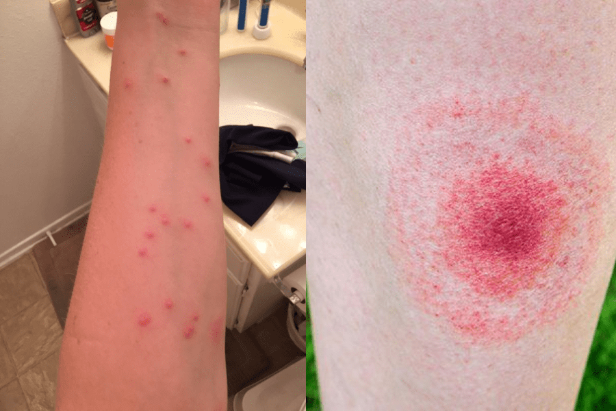 Bed Bug Bites (Left), Tick Bites (Right)