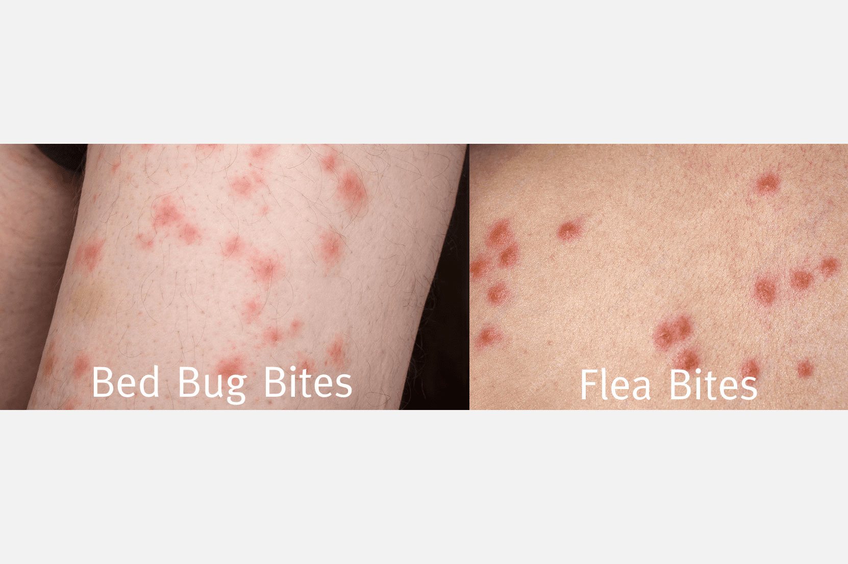 baby bed bug bites pictures