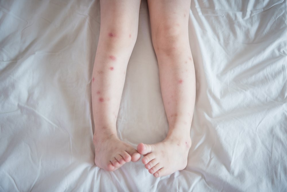 Bites on the Legs of a Child