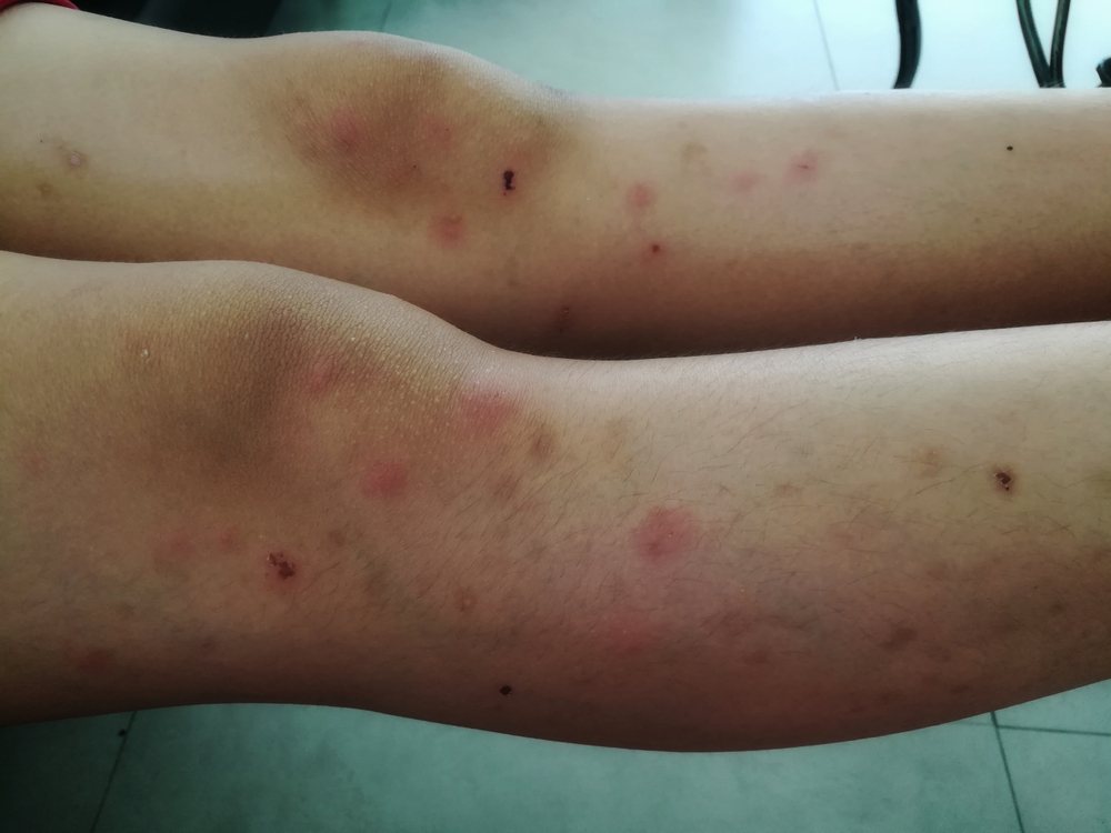 Bed bug bites and scarring