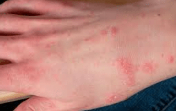 Scabies vs Bed Bugs