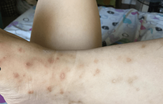 Bed Bug bite Scars on a Victim's Ankle