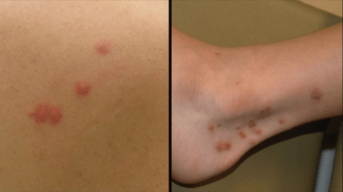 Bed Bug Bites vs. Flea Bites